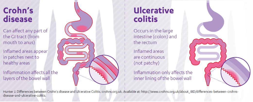 Engineered Probiotic For Treatment Of Ibd Inflammatory